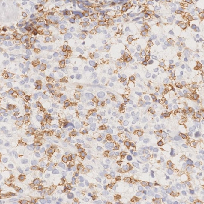 Immunohistochemistry (IHC) staining of human lymphoma tissue using CD8a Monoclonal antibody (66868-1-Ig)