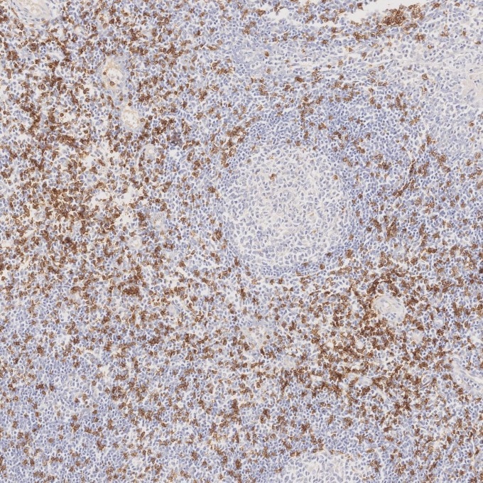 Immunohistochemistry (IHC) staining of human tonsillitis tissue using CD8a Monoclonal antibody (66868-1-Ig)