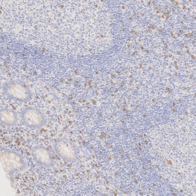 Immunohistochemistry (IHC) staining of human appendicitis tissue using CD8a Monoclonal antibody (66868-1-Ig)