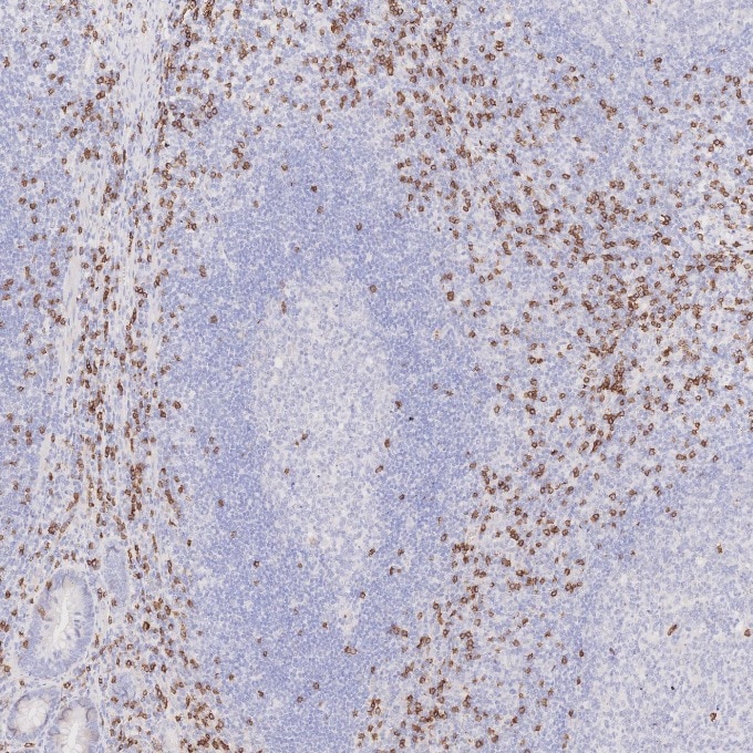 Immunohistochemistry (IHC) staining of human appendicitis tissue using CD8a Monoclonal antibody (66868-1-Ig)