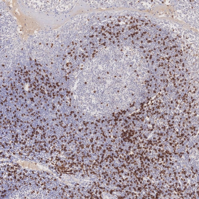 Immunohistochemistry (IHC) staining of human tonsillitis tissue using CD8a Monoclonal antibody (66868-1-Ig)