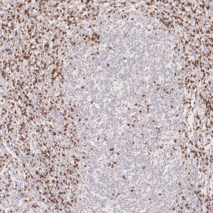 Immunohistochemistry (IHC) staining of human lymphoma tissue using CD8a Monoclonal antibody (66868-1-Ig)