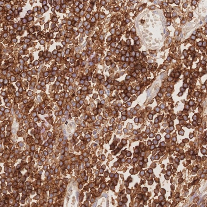 Immunohistochemistry (IHC) staining of human lymphoma tissue using CD8a Monoclonal antibody (66868-1-Ig)