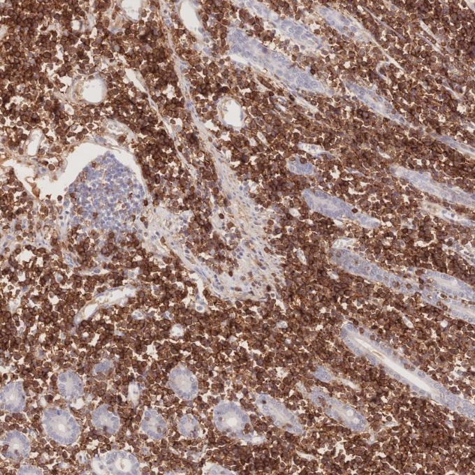 Immunohistochemistry (IHC) staining of human lymphoma tissue using CD8a Monoclonal antibody (66868-1-Ig)
