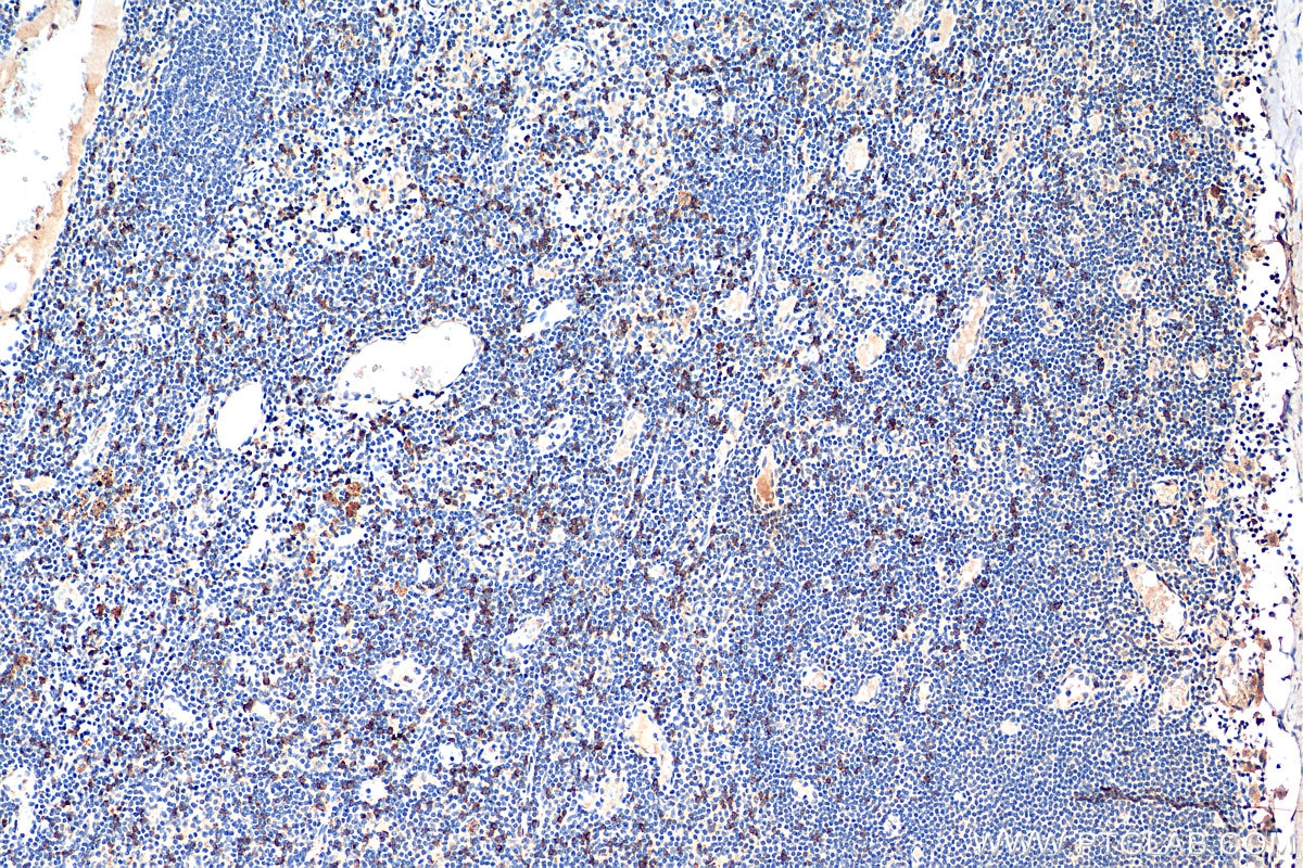 Immunohistochemistry (IHC) staining of human breast cancer tissue using CD8b Monoclonal antibody (68432-1-Ig)
