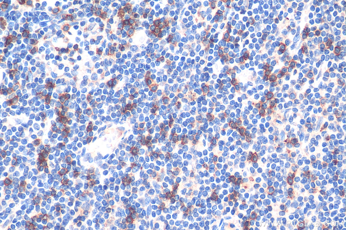 Immunohistochemistry (IHC) staining of human breast cancer tissue using CD8b Monoclonal antibody (68432-1-Ig)