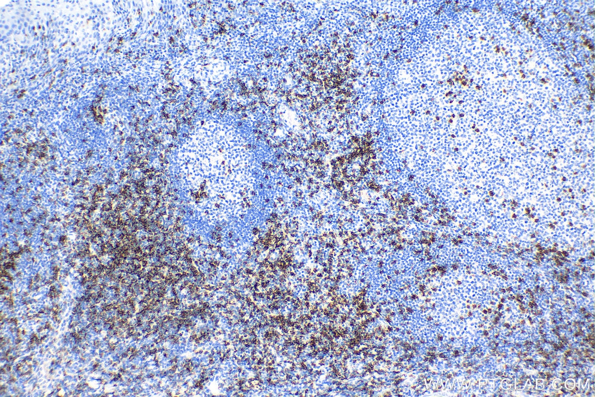 Immunohistochemistry (IHC) staining of human tonsillitis tissue using CD8a Recombinant antibody (86063-2-RR)