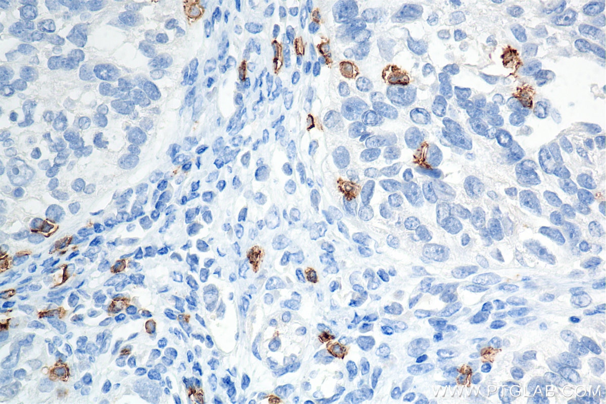 Immunohistochemistry (IHC) staining of human ovary cancer tissue using CD8a Recombinant antibody (86063-2-RR)