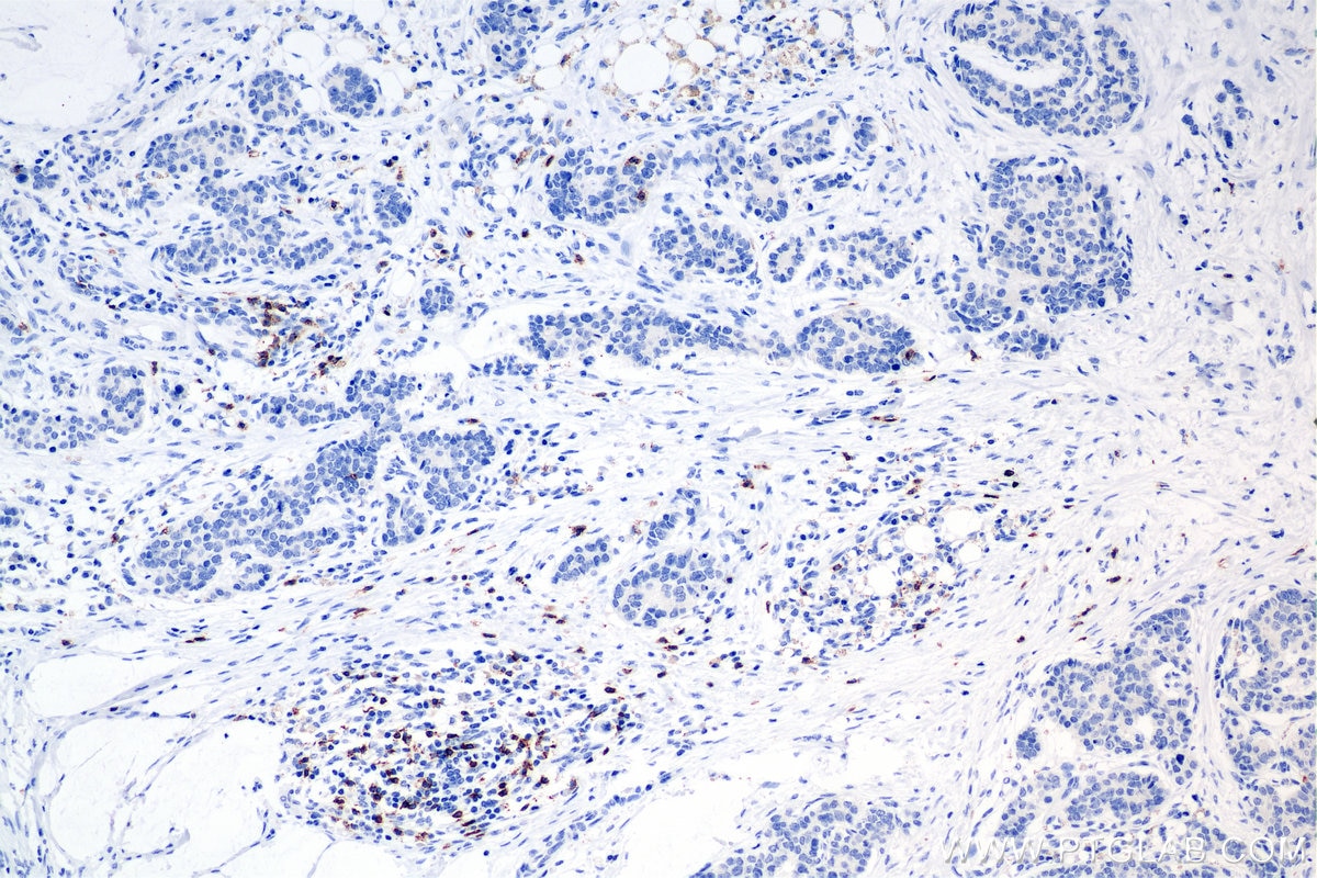 Immunohistochemistry (IHC) staining of human stomach cancer tissue using CD8a Recombinant antibody (86063-2-RR)