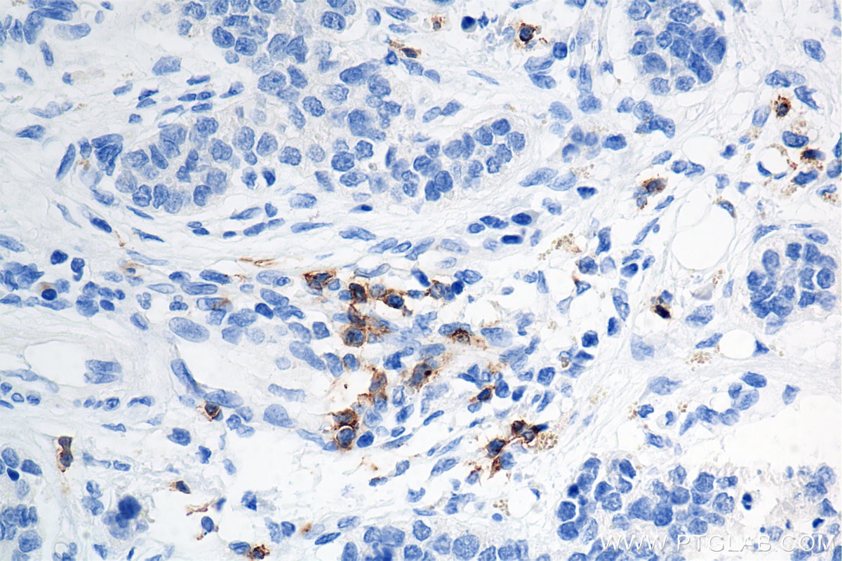 Immunohistochemistry (IHC) staining of human stomach cancer tissue using CD8a Recombinant antibody (86063-2-RR)