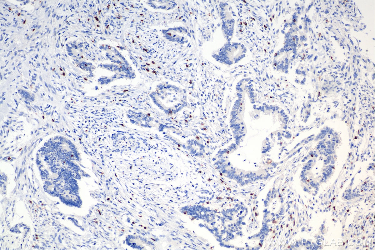 Immunohistochemistry (IHC) staining of human rectal cancer tissue using CD8a Recombinant antibody (86063-2-RR)
