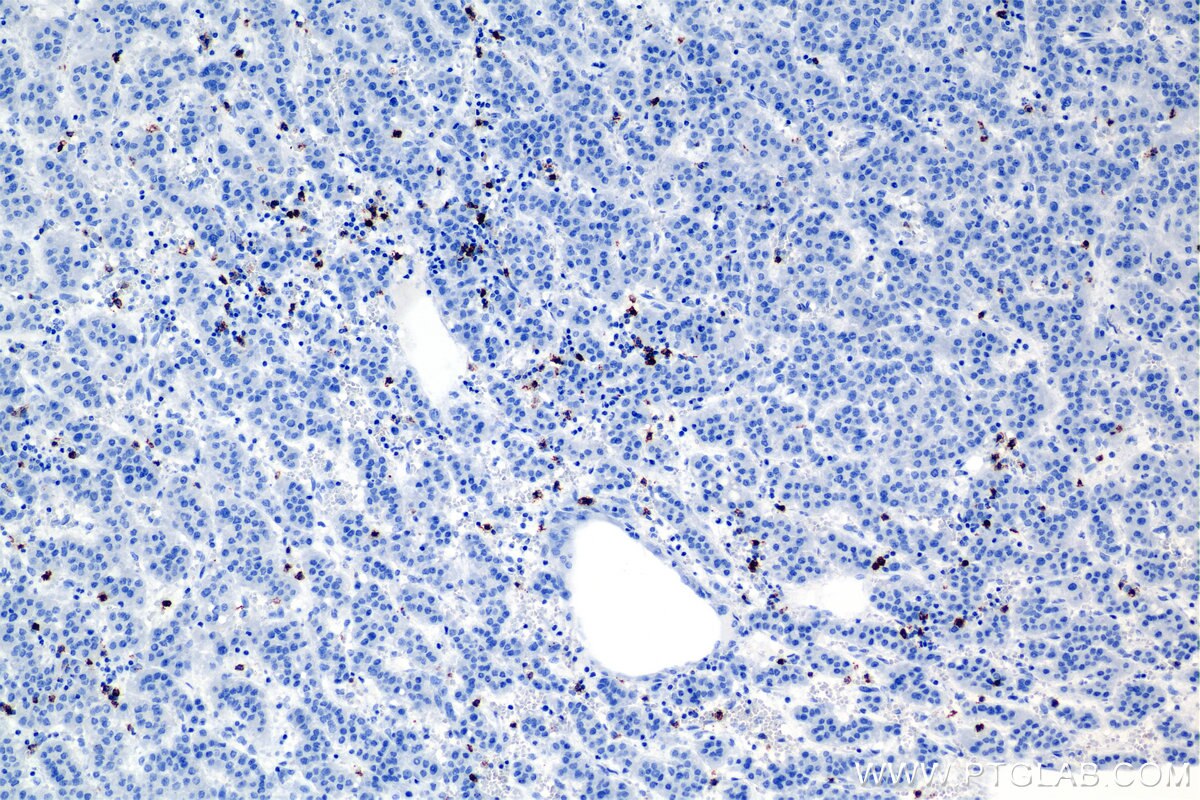Immunohistochemistry (IHC) staining of human hepatocellular cancer using CD8a Recombinant antibody (86063-2-RR)