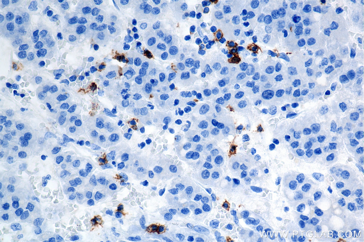 Immunohistochemistry (IHC) staining of human hepatocellular cancer using CD8a Recombinant antibody (86063-2-RR)