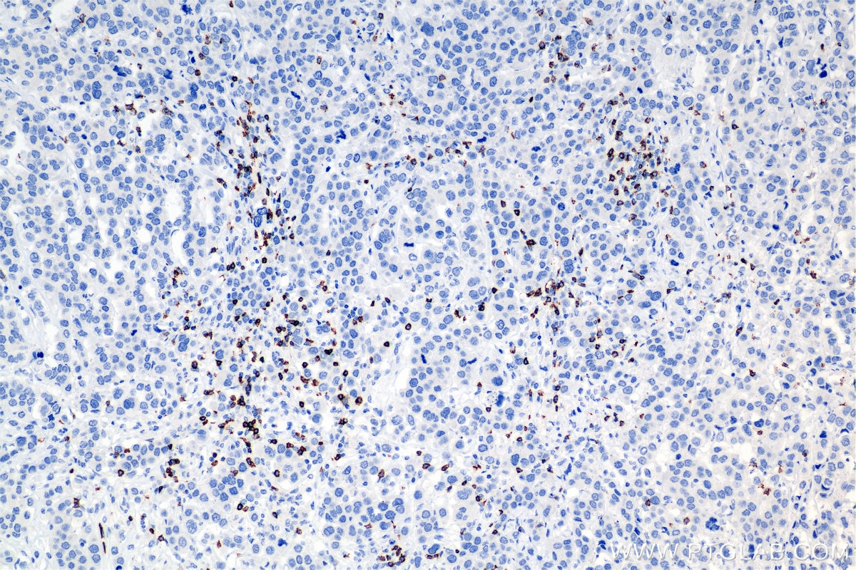 Immunohistochemistry (IHC) staining of human breast cancer tissue using CD8a Recombinant antibody (86063-2-RR)