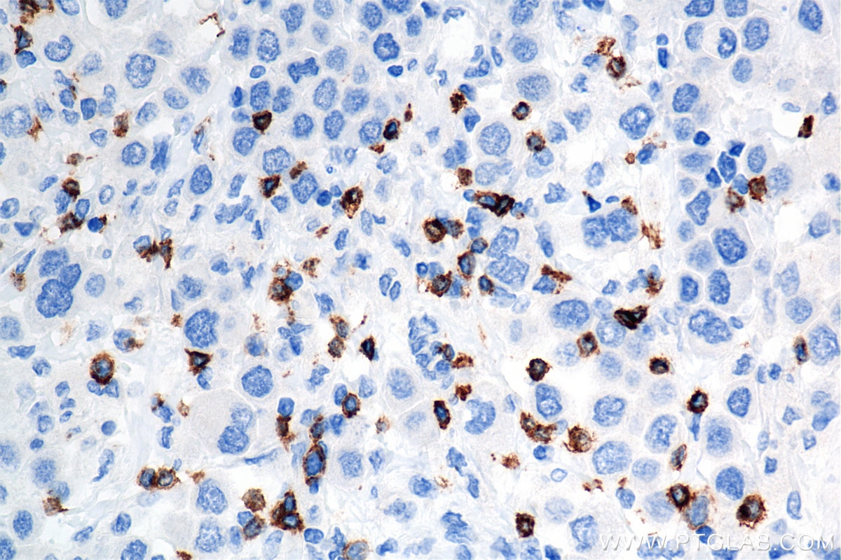 Immunohistochemistry (IHC) staining of human breast cancer tissue using CD8a Recombinant antibody (86063-2-RR)