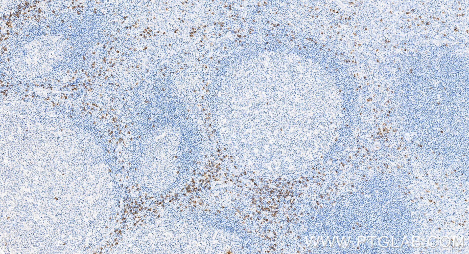 Immunohistochemistry (IHC) staining of human tonsillitis tissue using CD8a Recombinant monoclonal antibody (86063-2-RR)