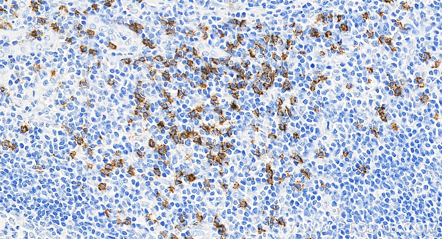 Immunohistochemistry (IHC) staining of human tonsillitis tissue using CD8a Recombinant monoclonal antibody (86063-2-RR)