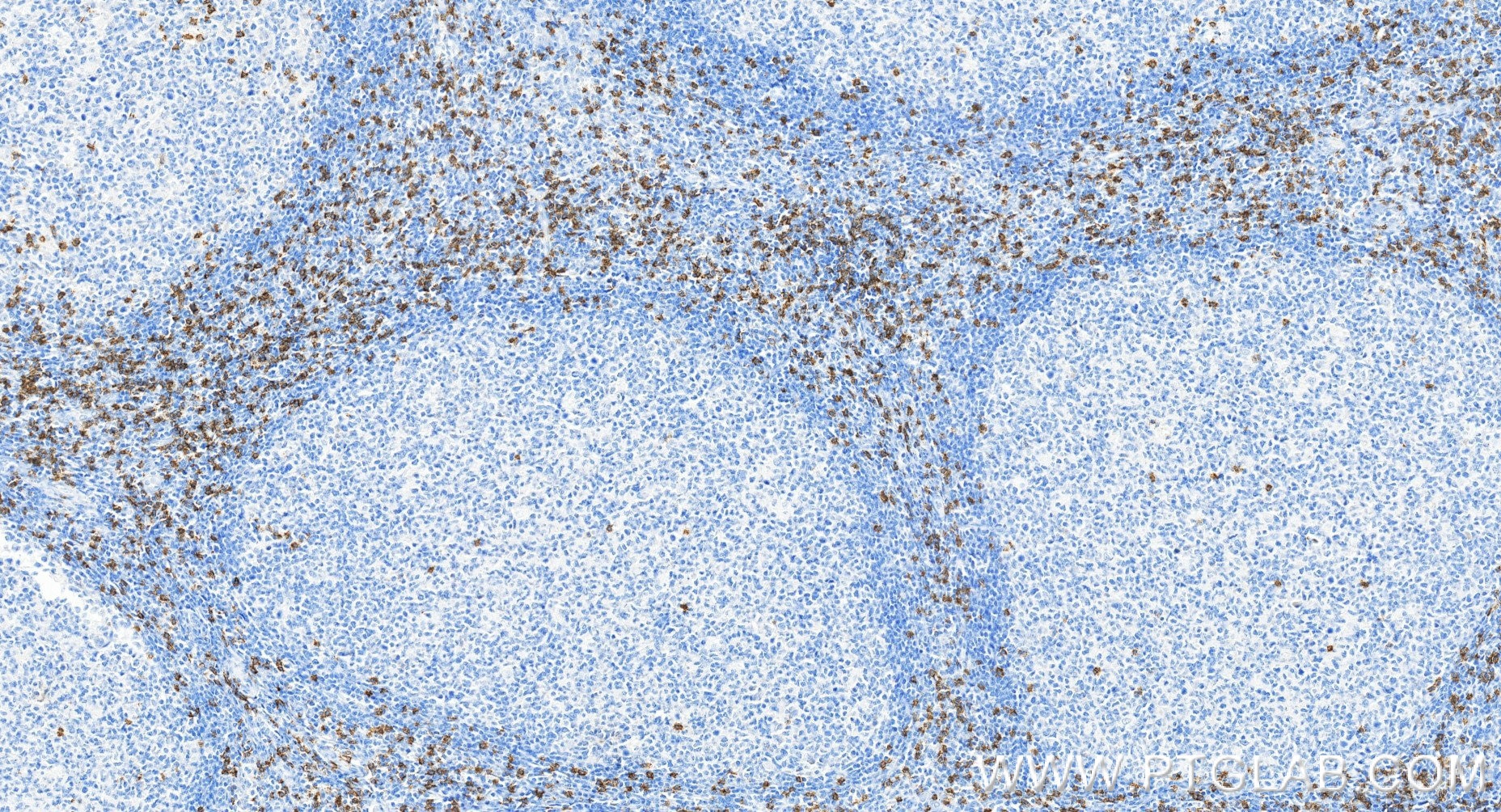Immunohistochemistry (IHC) staining of human tonsillitis tissue using Anti-Human CD8a Rabbit Recombinant Antibody (98470-2-RR)