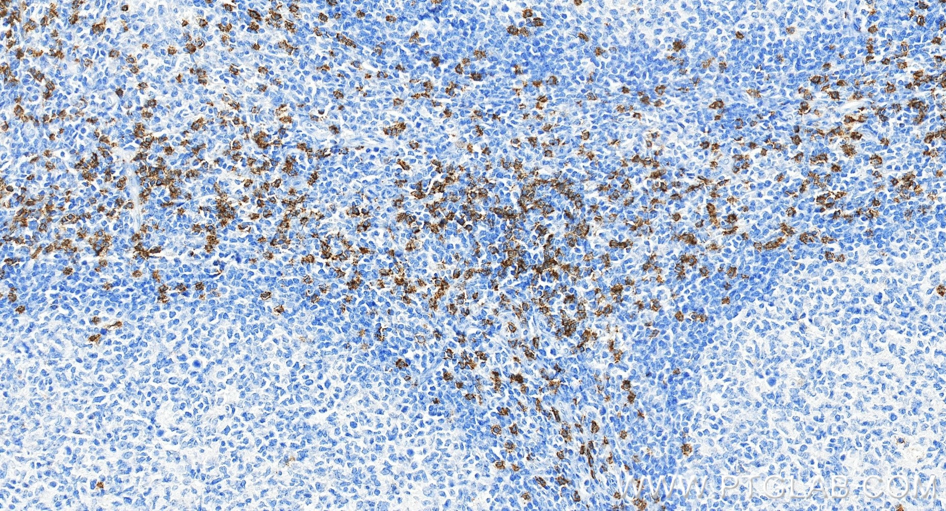 Immunohistochemistry (IHC) staining of human tonsillitis tissue using Anti-Human CD8a Rabbit Recombinant Antibody (98470-2-RR)
