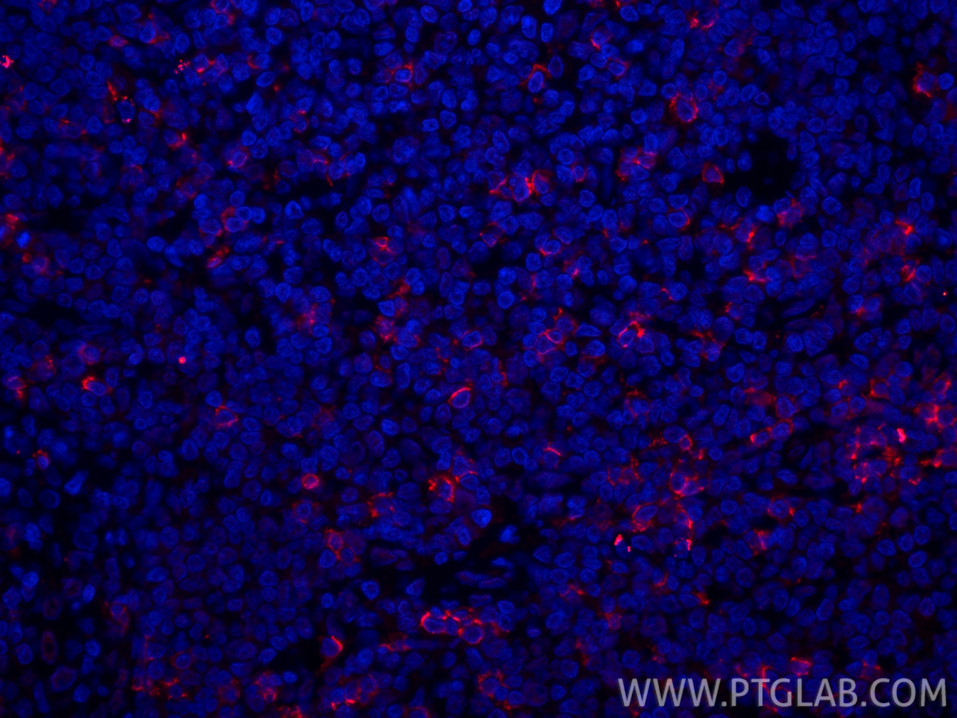 Immunofluorescence (IF) / fluorescent staining of human tonsillitis tissue using CoraLite®594-conjugated CD8a Recombinant monoclona (CL594-86063-2)