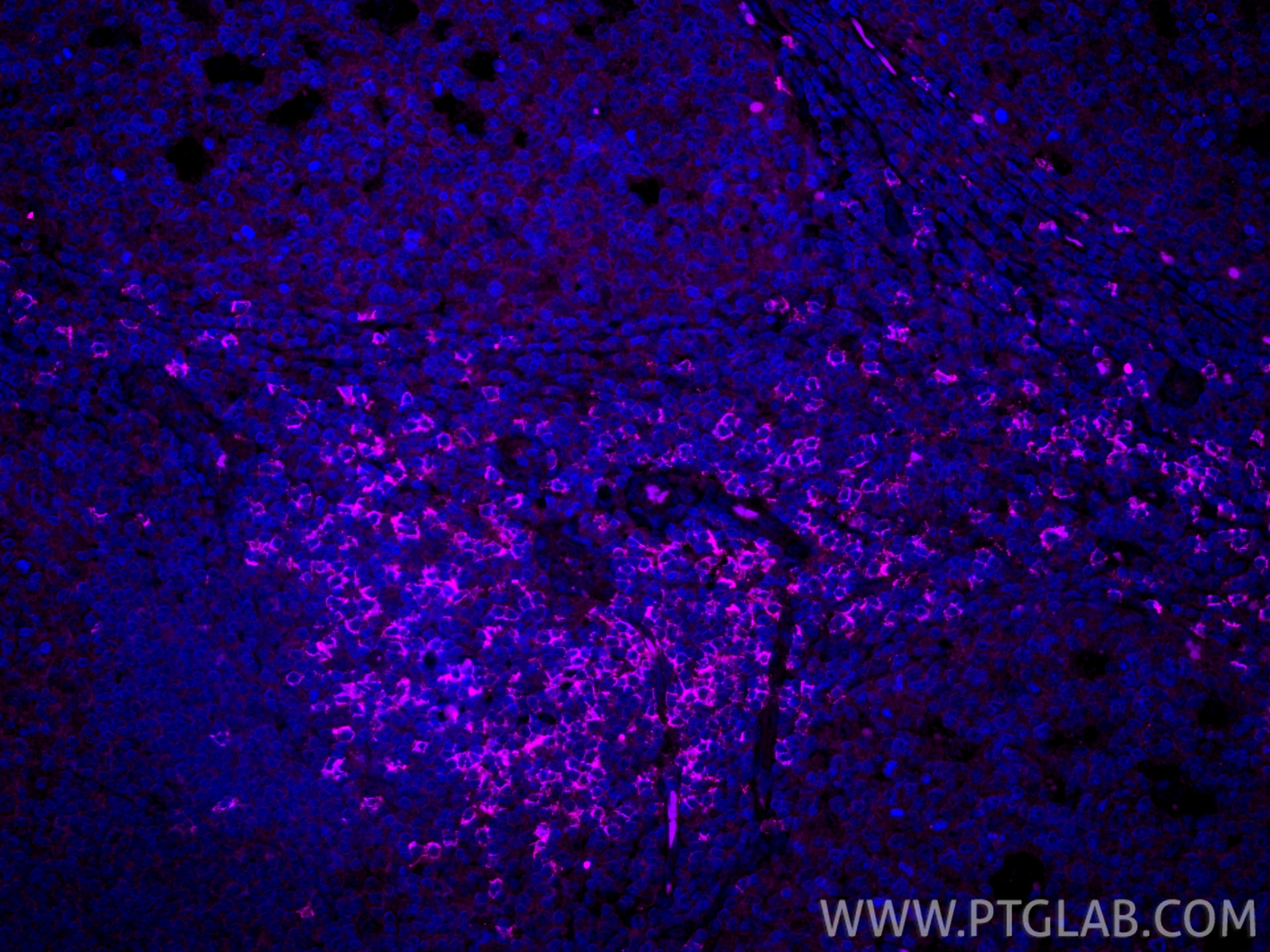 IF Staining of human tonsillitis using CL647-86063-2 Immunofluorescence (IF) / fluorescent staining of human tonsillitis tissue using CoraLite® Plus 647-conjugated CD8a Recombinant mon (CL647-86063-2)