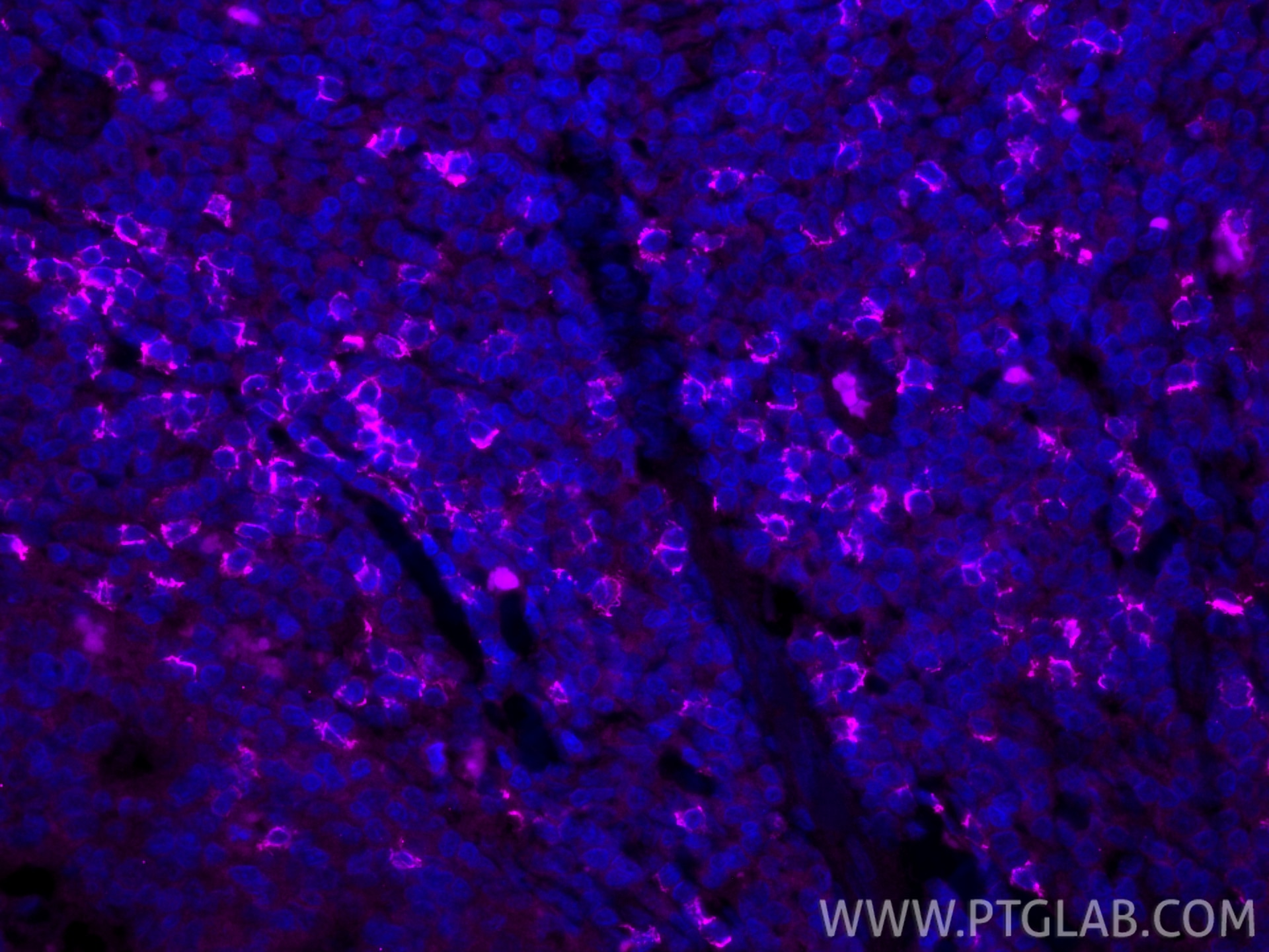 IF Staining of human tonsillitis using CL647-86063-2 Immunofluorescence (IF) / fluorescent staining of human tonsillitis tissue using CoraLite® Plus 647-conjugated CD8a Recombinant mon (CL647-86063-2)