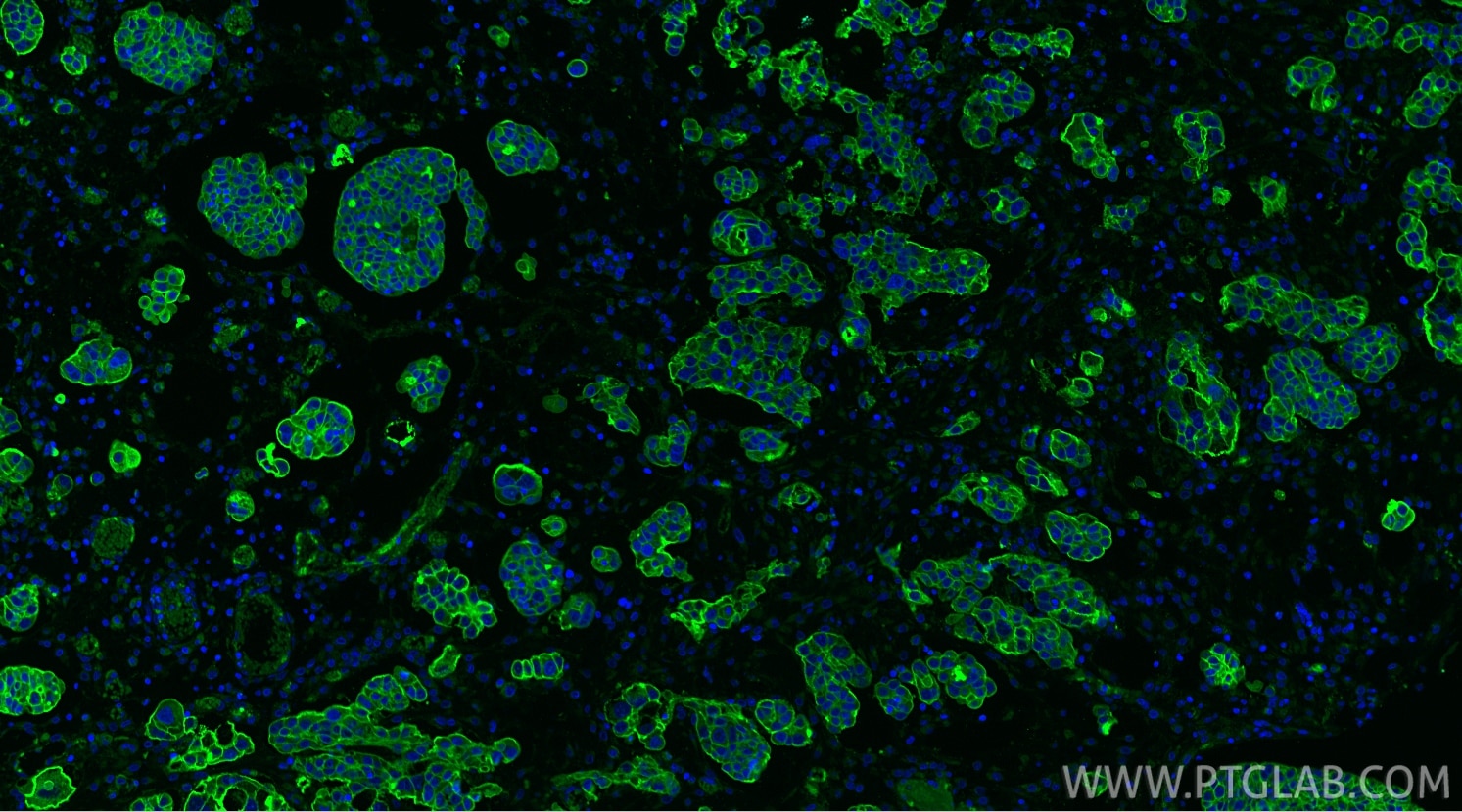 IF Staining of human ovary cancer using 20597-1-AP Immunofluorescence (IF) / fluorescent staining of human ovary cancer tissue using CD9 Polyclonal antibody (20597-1-AP)