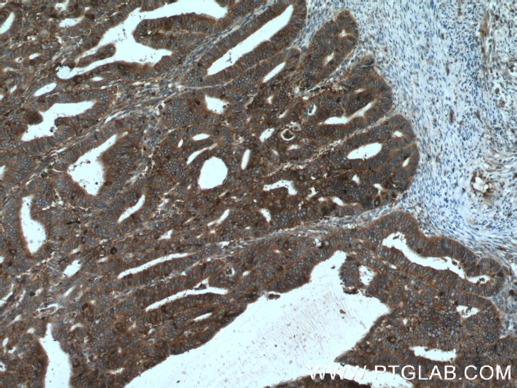 IHC staining of human endometrial cancer using 20597-1-AP