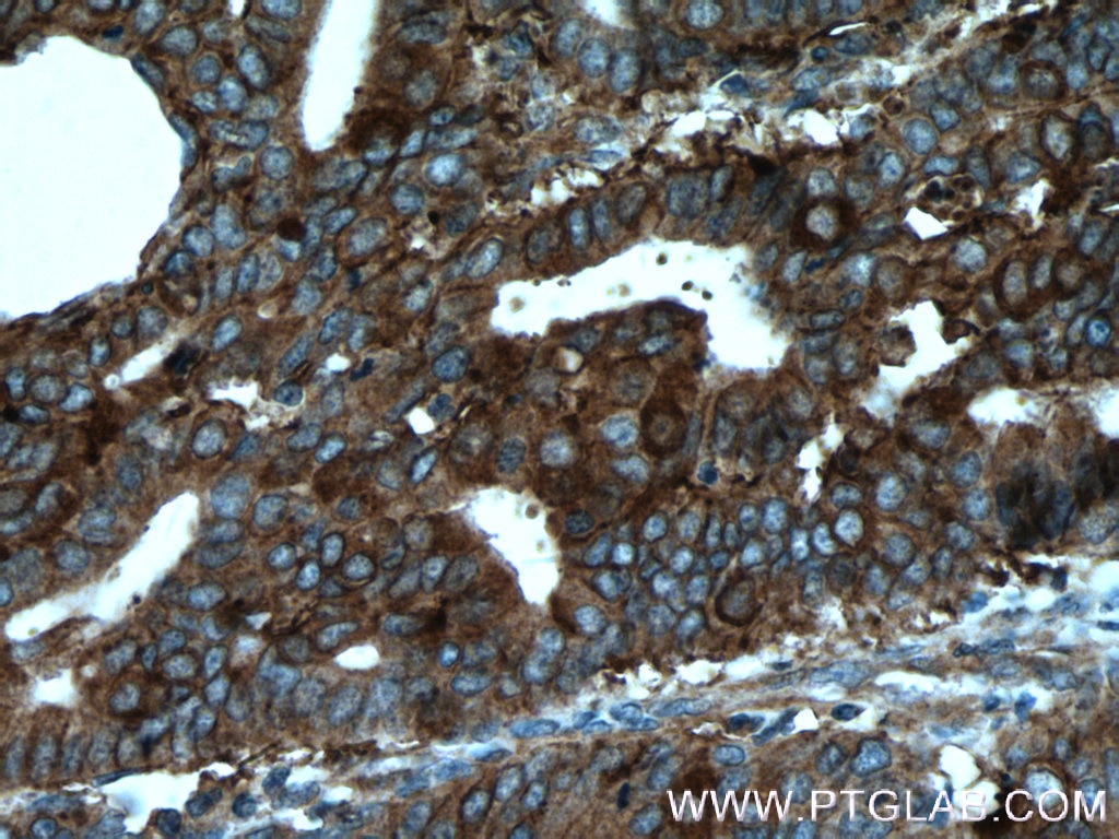 IHC staining of human endometrial cancer using 20597-1-AP