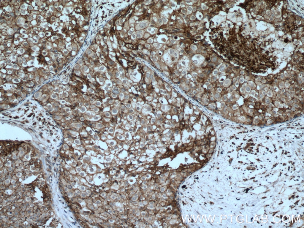 Immunohistochemistry (IHC) staining of human breast cancer tissue using CD9 Polyclonal antibody (20597-1-AP)