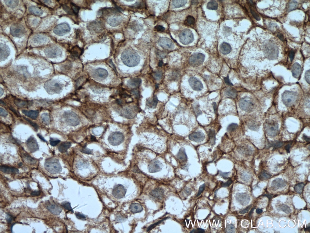 Immunohistochemistry (IHC) staining of human breast cancer tissue using CD9 Polyclonal antibody (20597-1-AP)