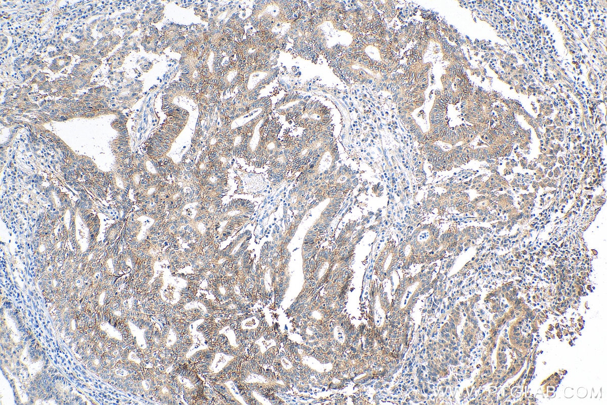 Immunohistochemistry (IHC) staining of human endometrial cancer tissue using CD9 Polyclonal antibody (20597-1-AP)