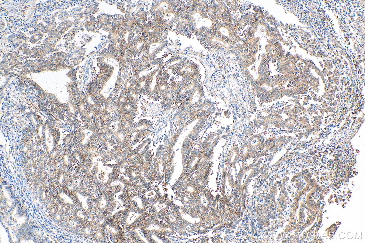 IHC staining of human endometrial cancer using 20597-1-AP