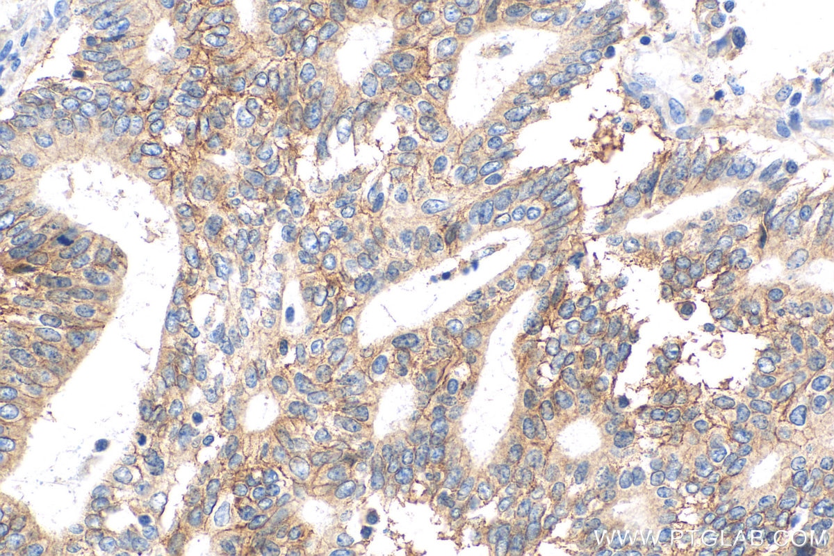 Immunohistochemistry (IHC) staining of human endometrial cancer tissue using CD9 Polyclonal antibody (20597-1-AP)