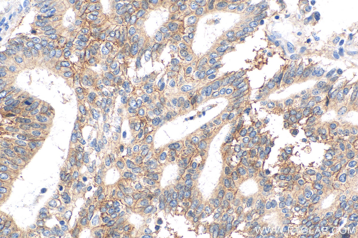 IHC staining of human endometrial cancer using 20597-1-AP