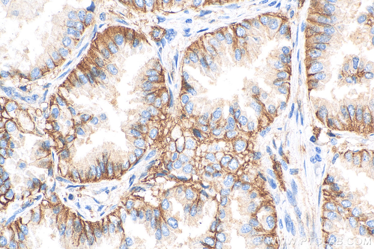 Immunohistochemistry (IHC) staining of human lung cancer tissue using CD9 Polyclonal antibody (20597-1-AP)