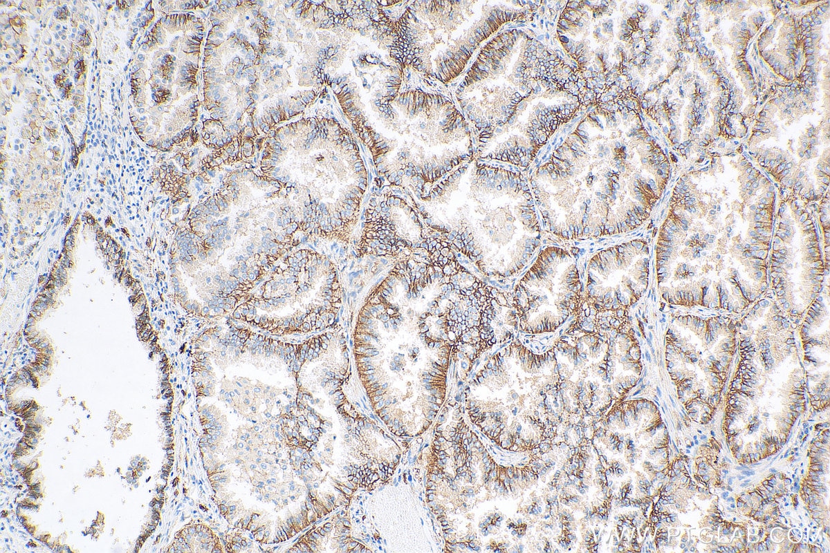 Immunohistochemistry (IHC) staining of human lung cancer tissue using CD9 Polyclonal antibody (20597-1-AP)