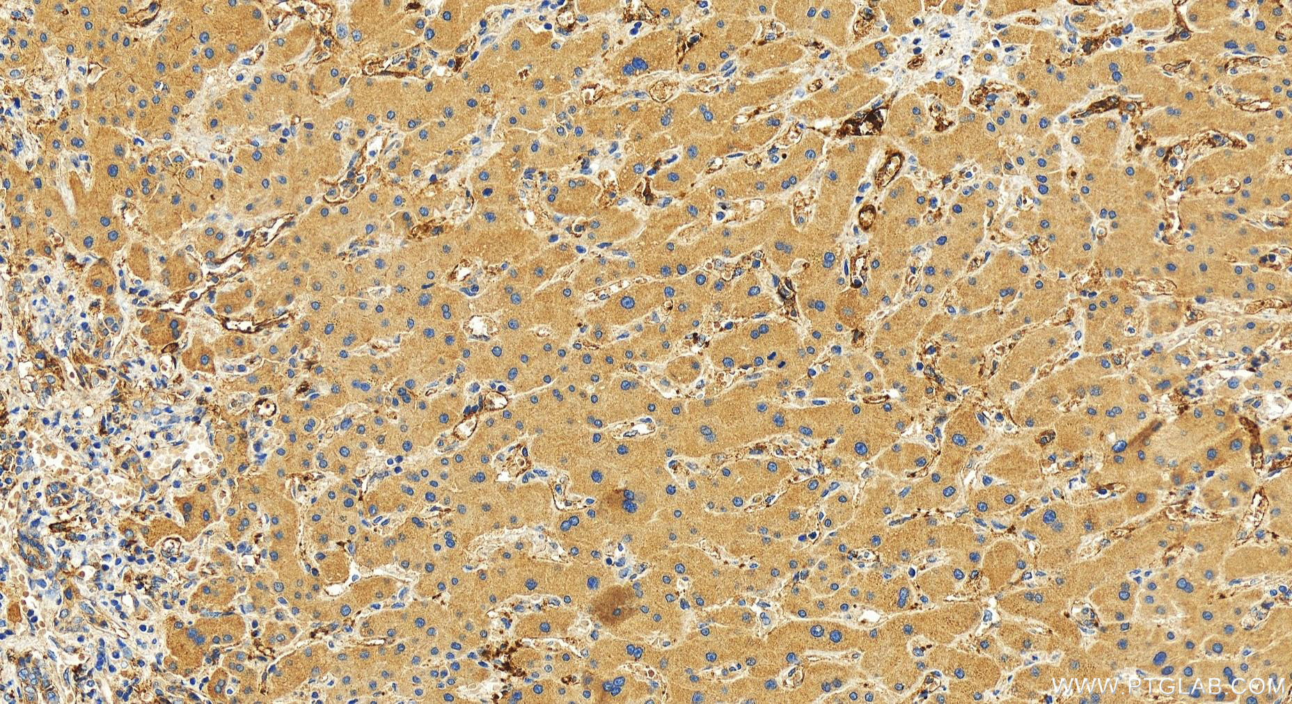 Immunohistochemistry (IHC) staining of human intrahepatic cholangiocarcinoma tissue using CD9 Polyclonal antibody (31514-1-AP)