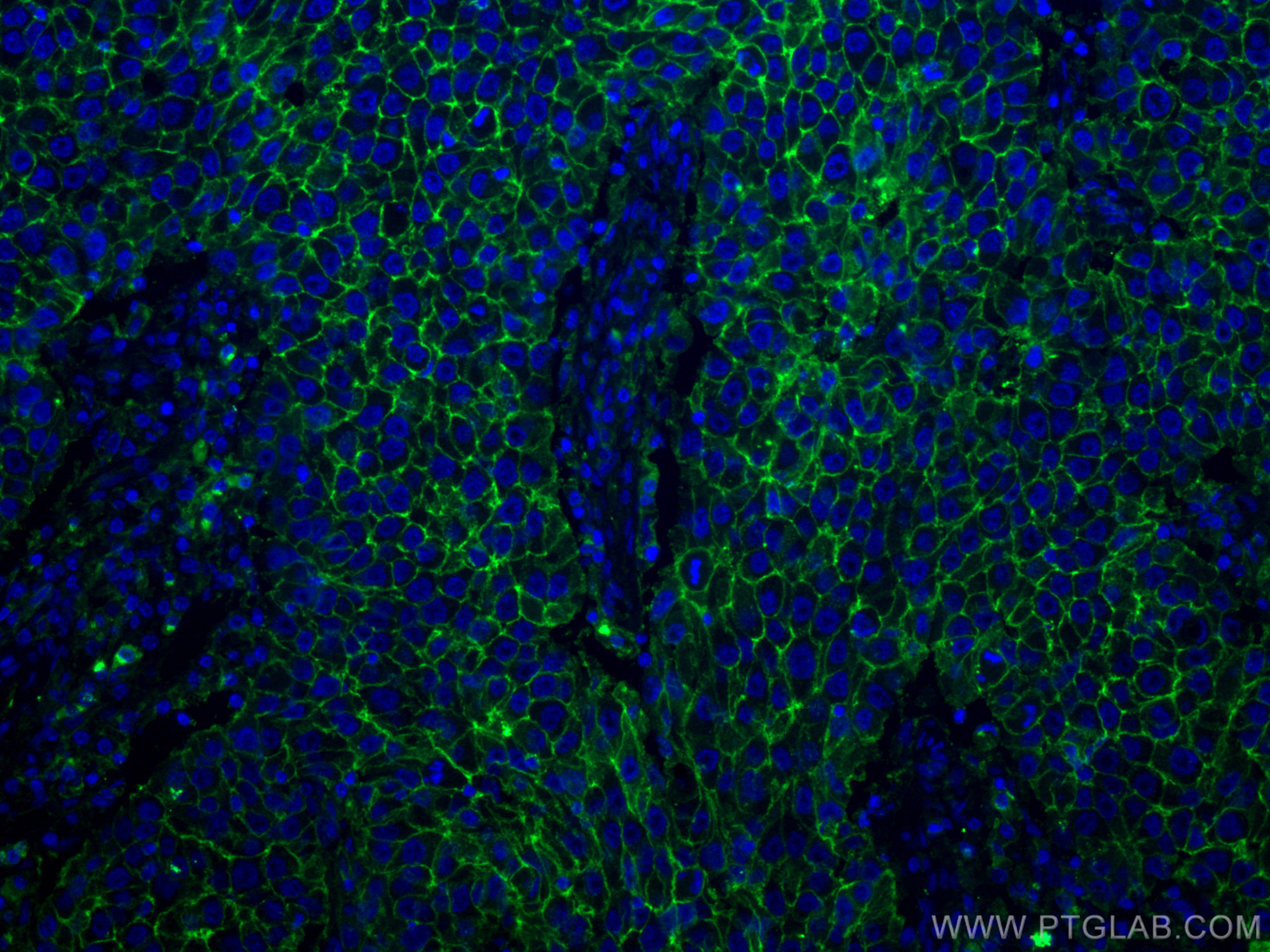 Immunofluorescence (IF) / fluorescent staining of human breast cancer tissue using CD9 Monoclonal antibody (60232-1-Ig)