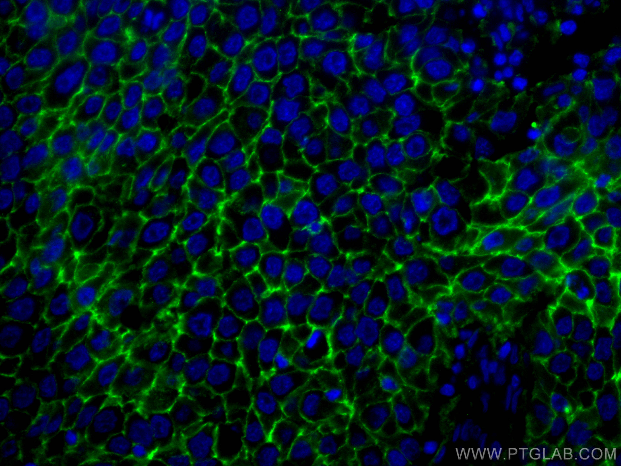 Immunofluorescence (IF) / fluorescent staining of human breast cancer tissue using CD9 Monoclonal antibody (60232-1-Ig)