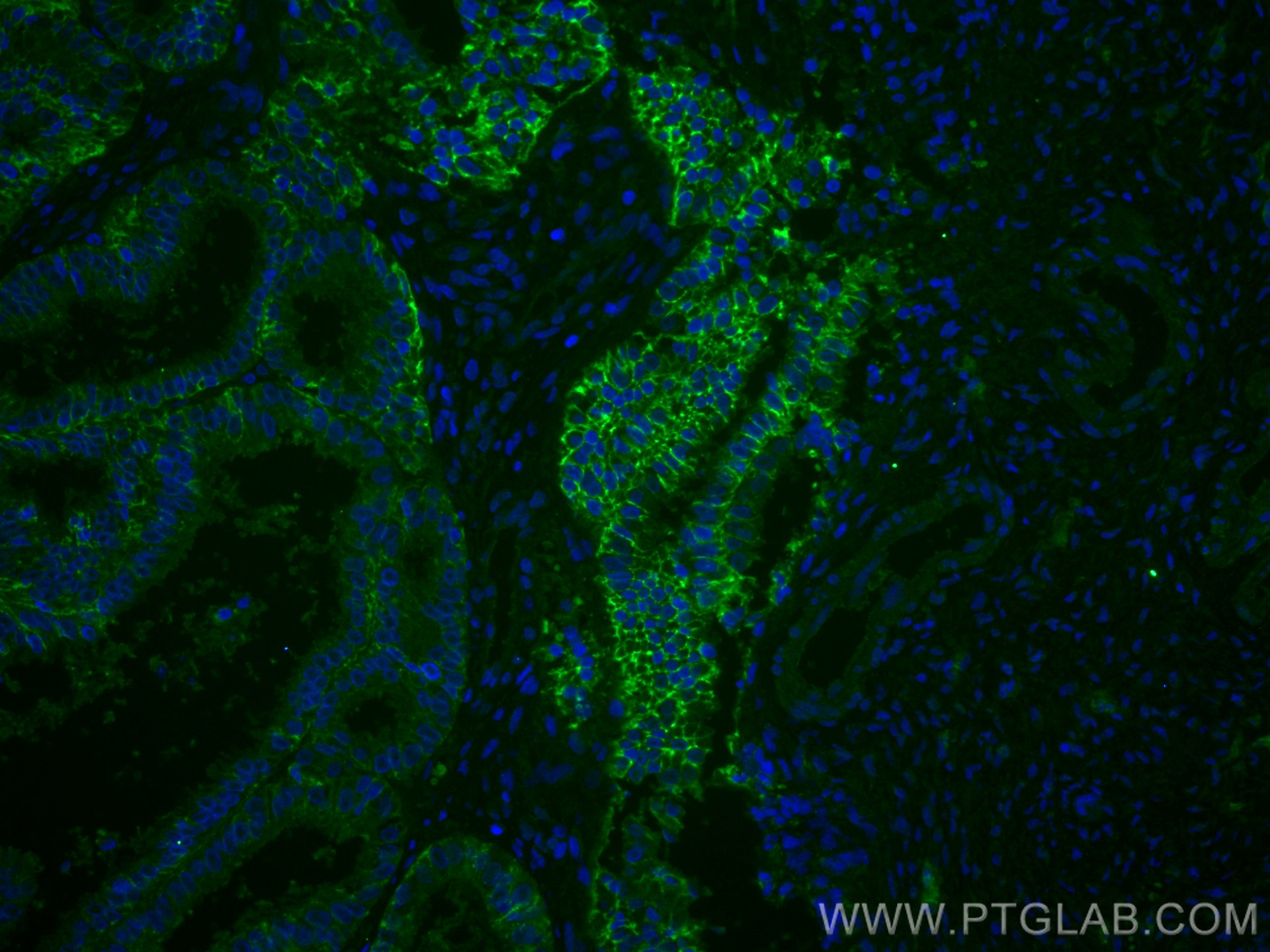 Immunofluorescence (IF) / fluorescent staining of human ovary tumor tissue using CD9 Monoclonal antibody (60232-1-Ig)