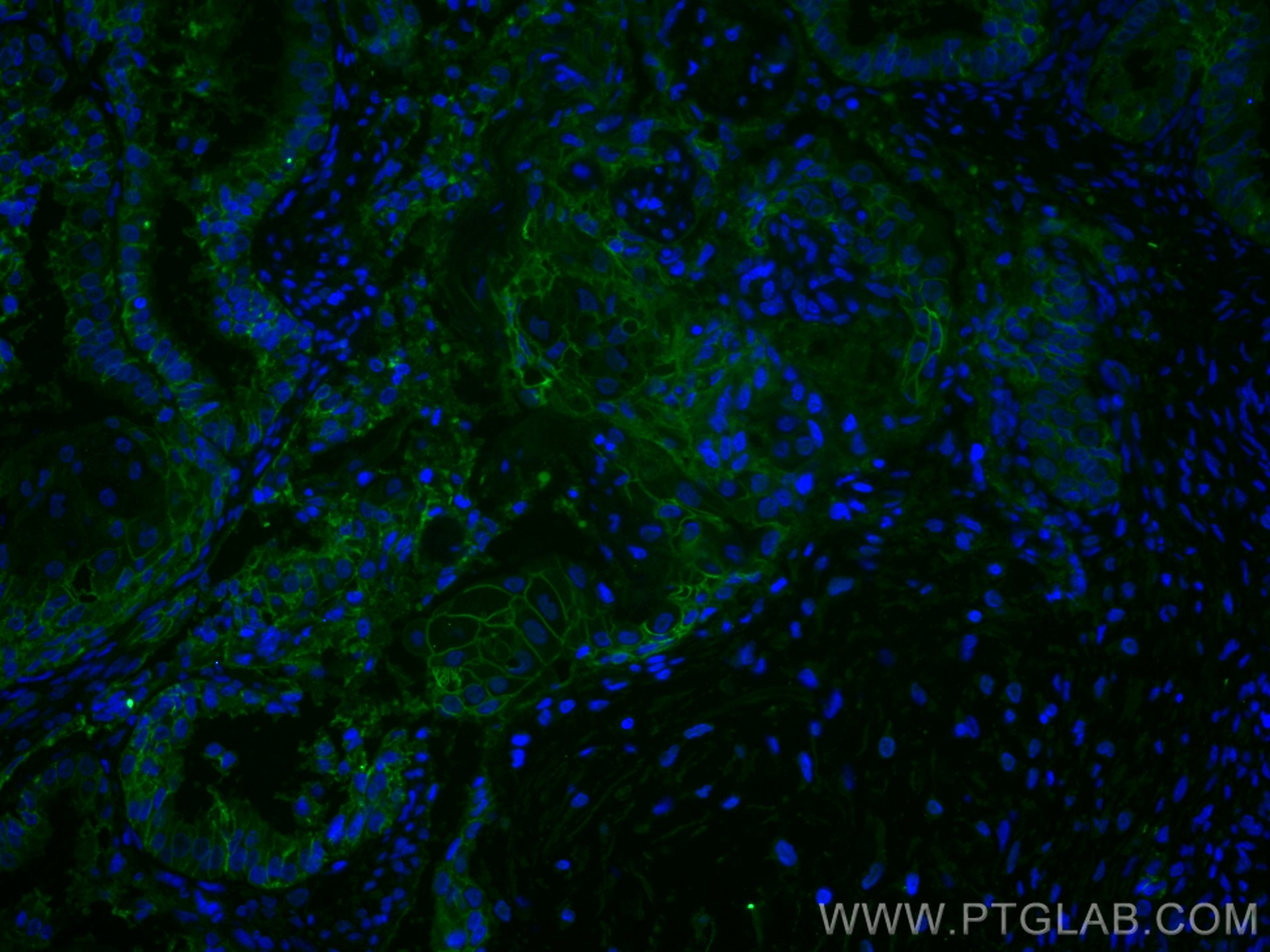Immunofluorescence (IF) / fluorescent staining of human ovary tumor tissue using CD9 Monoclonal antibody (60232-1-Ig)