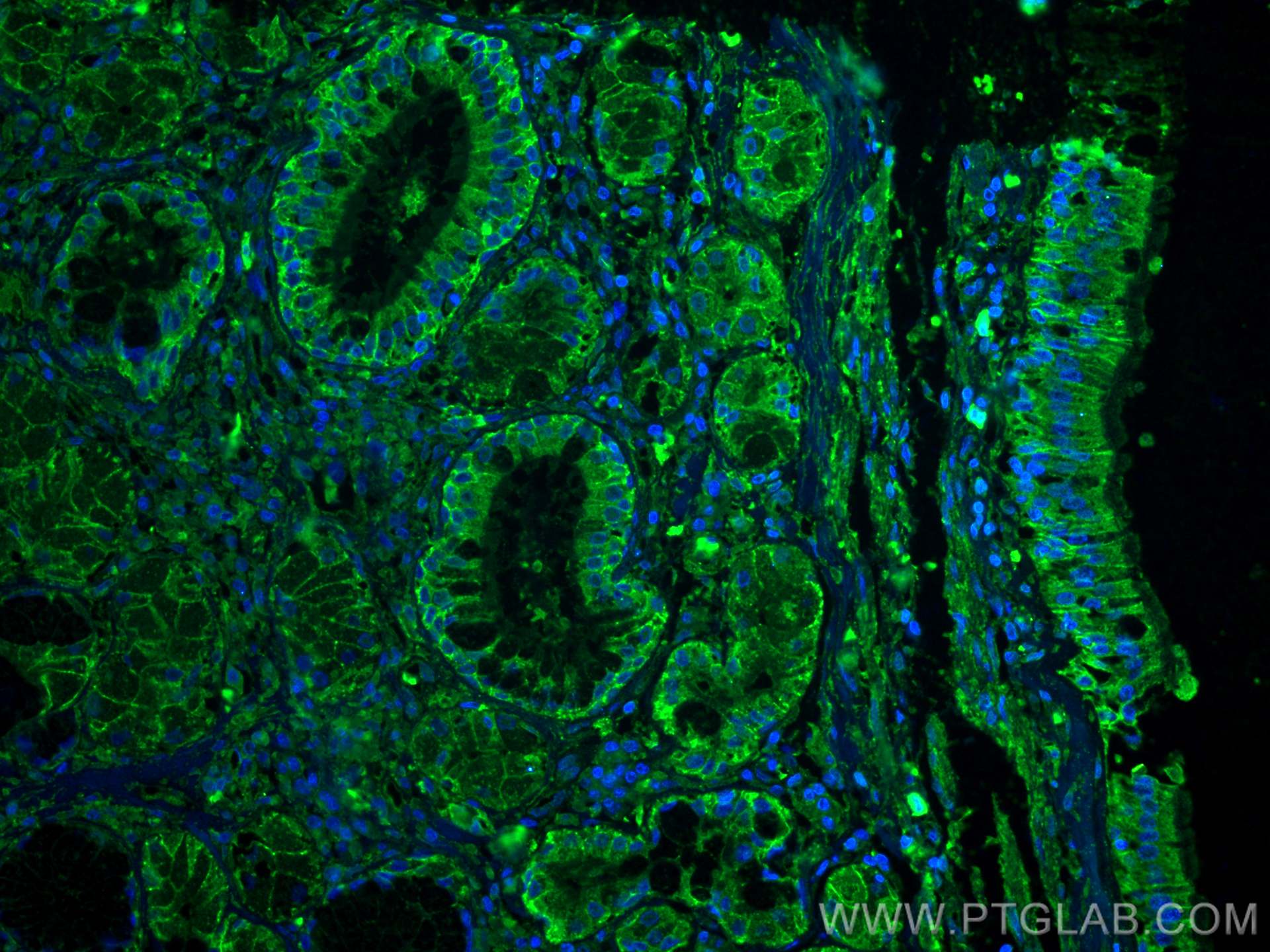 Immunofluorescence (IF) / fluorescent staining of human lung cancer tissue using CD9 Monoclonal antibody (60232-1-Ig)