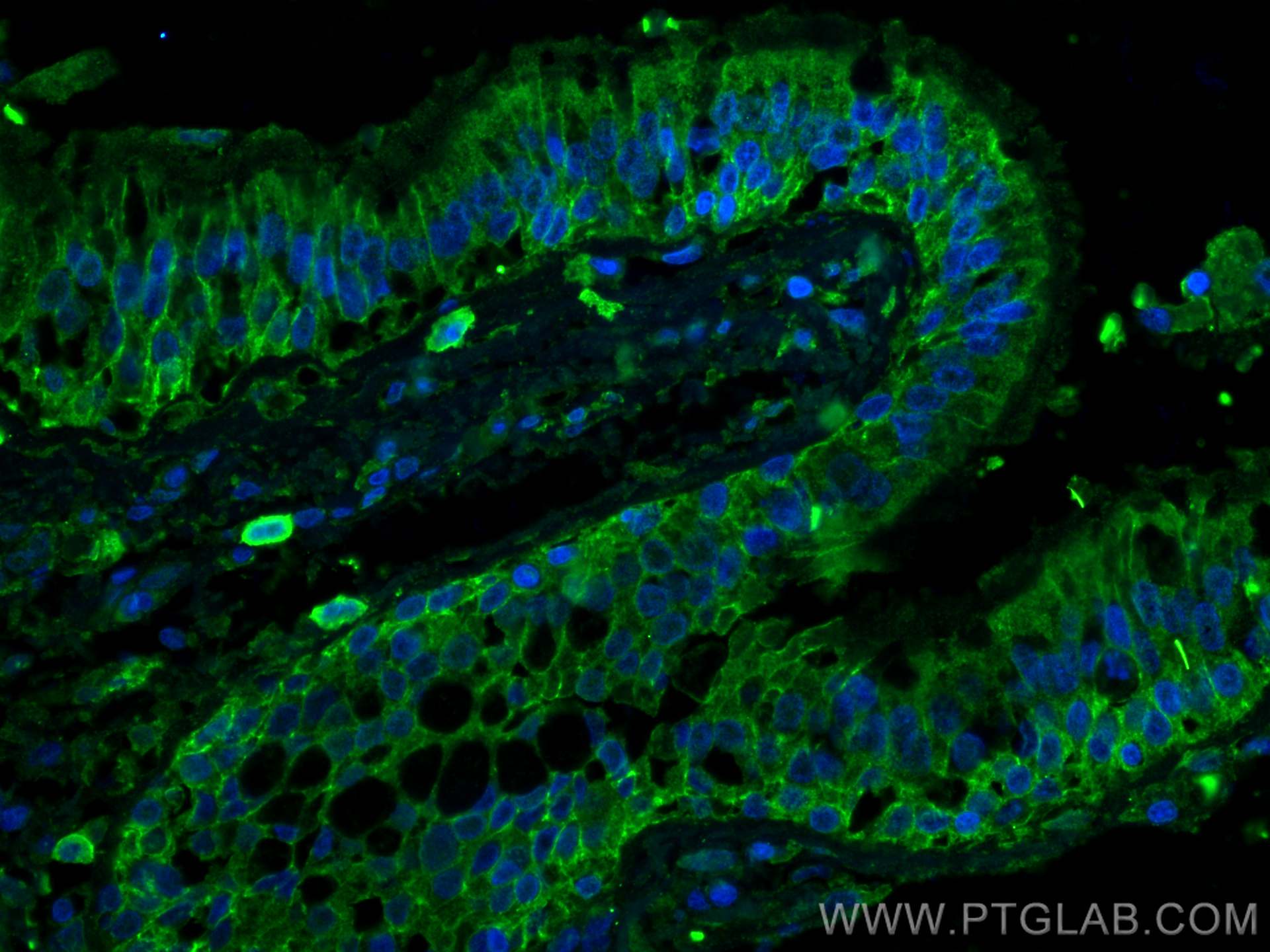 Immunofluorescence (IF) / fluorescent staining of human lung cancer tissue using CD9 Monoclonal antibody (60232-1-Ig)