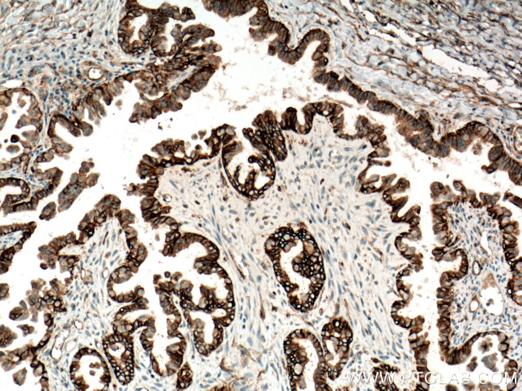 Immunohistochemistry (IHC) staining of human ovary tumor tissue using CD9 Monoclonal antibody (60232-1-Ig)