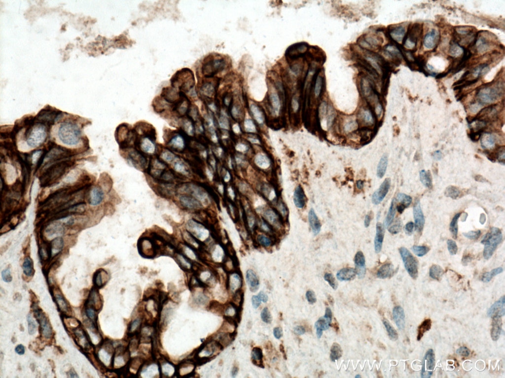 Immunohistochemistry (IHC) staining of human ovary tumor tissue using CD9 Monoclonal antibody (60232-1-Ig)