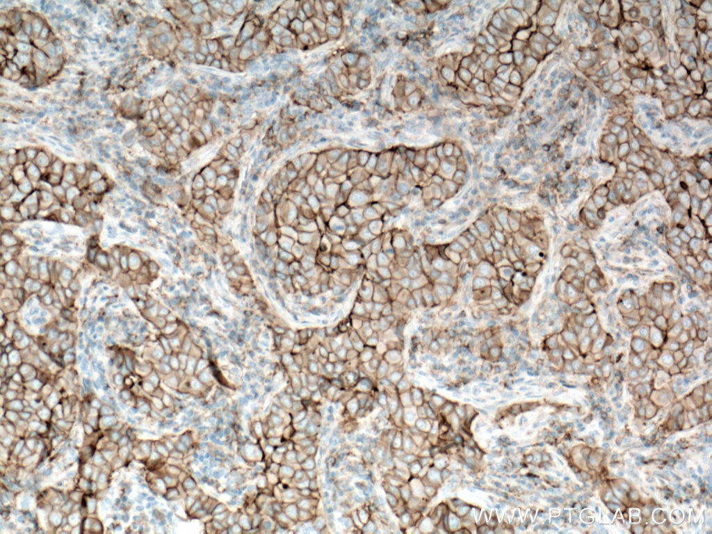 Immunohistochemistry (IHC) staining of human breast cancer tissue using CD9 Monoclonal antibody (60232-1-Ig)