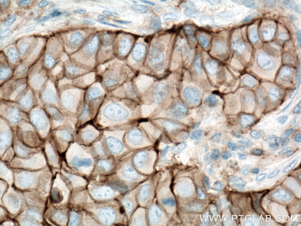 Immunohistochemistry (IHC) staining of human breast cancer tissue using CD9 Monoclonal antibody (60232-1-Ig)
