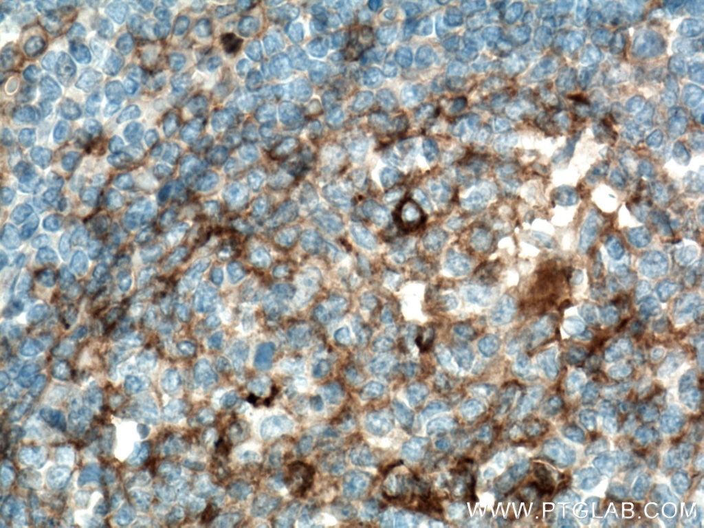 Immunohistochemistry (IHC) staining of human tonsillitis tissue using CD9 Monoclonal antibody (60232-1-Ig)