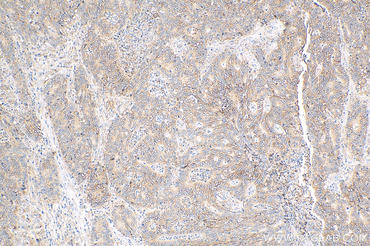 Immunohistochemistry (IHC) staining of human colon cancer tissue using CD9 Monoclonal antibody (60232-1-Ig)